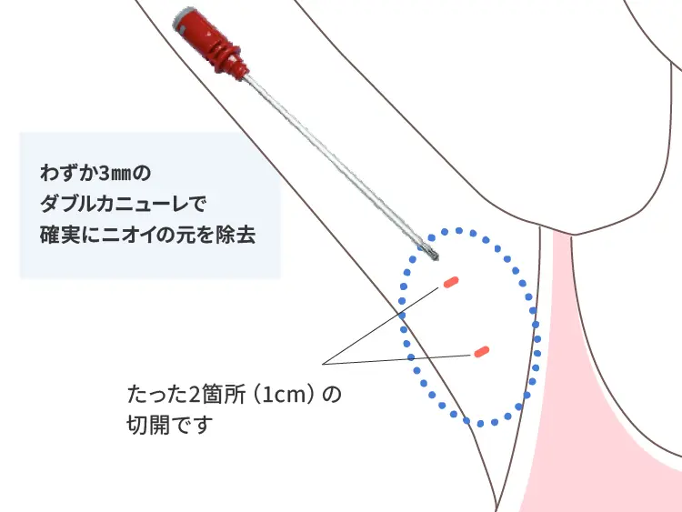 クワドラカット法とは?