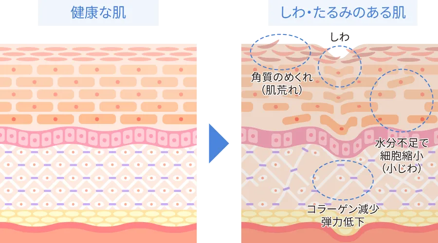 しわ・たるみのある肌の状態